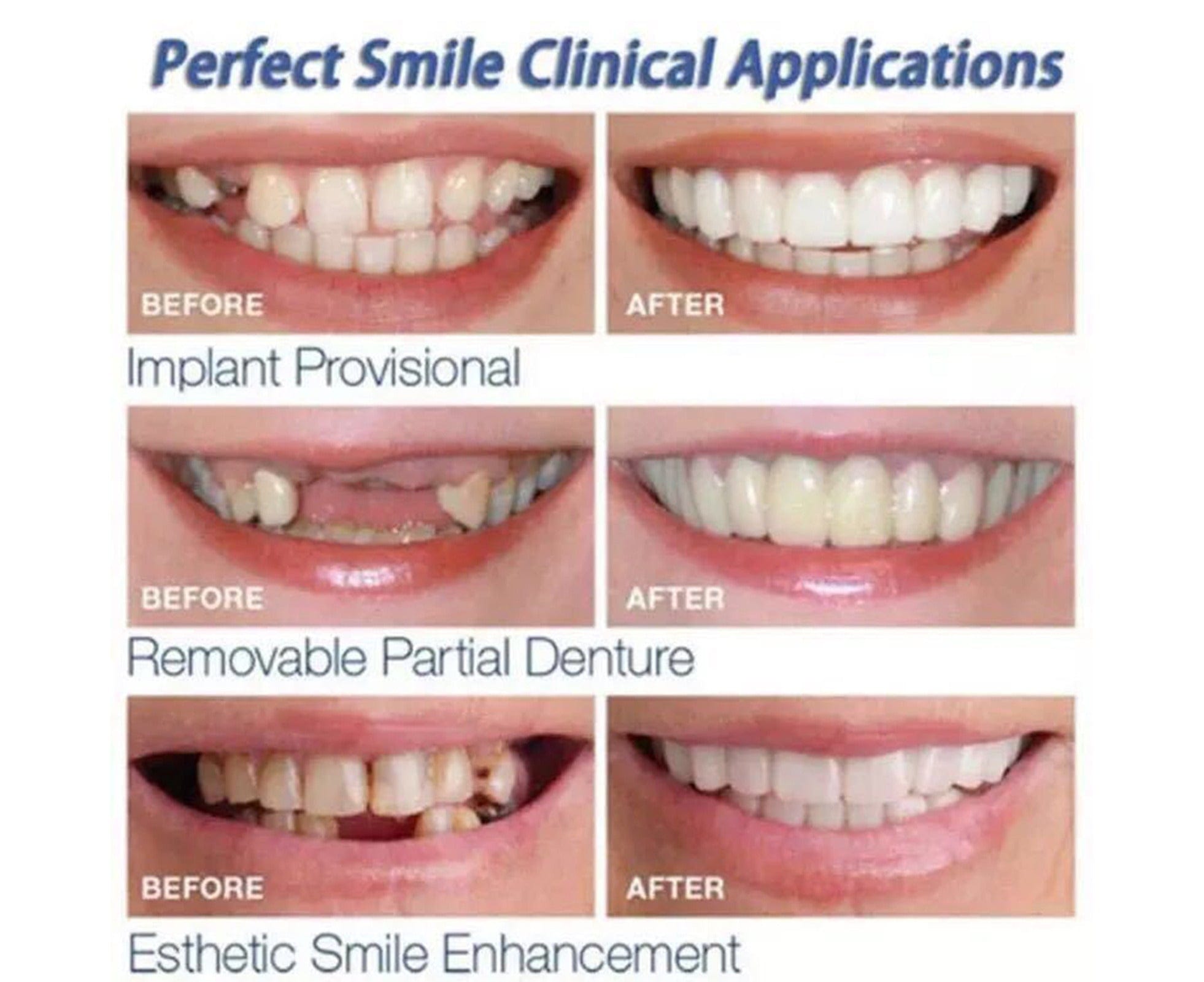 Ezysmyl™️ | White Teeth Braces Clip On Veneer Teeth Perfect Dental Braces - Ezysmyl™️ Ezysmyl™️ Zaavio®