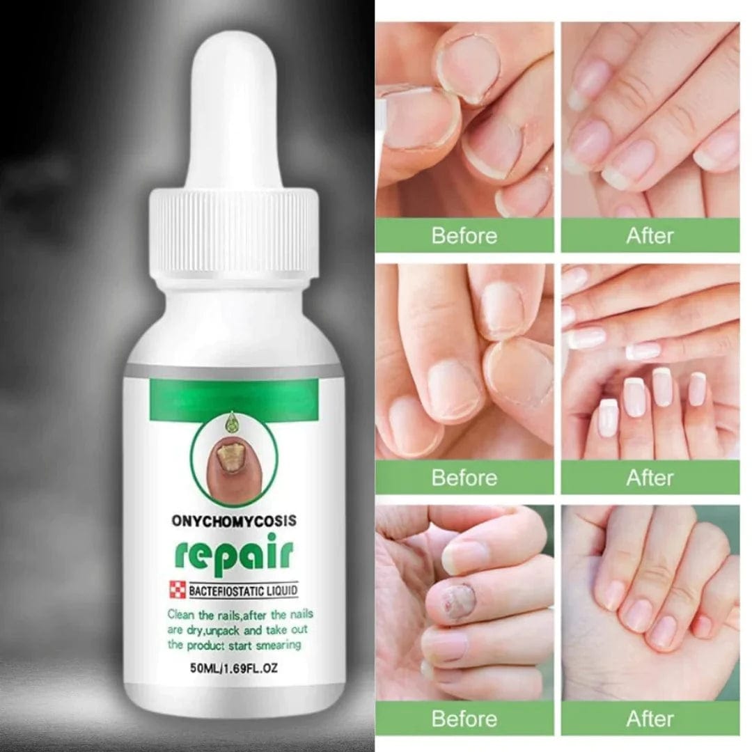 Kurizox™️ Nail Serum (Pack of 2) | Brittle Nails Grow Nail Manicure Transparent Serum Kurizox™️ Nail Serum (Pack of 2) Zaavio®