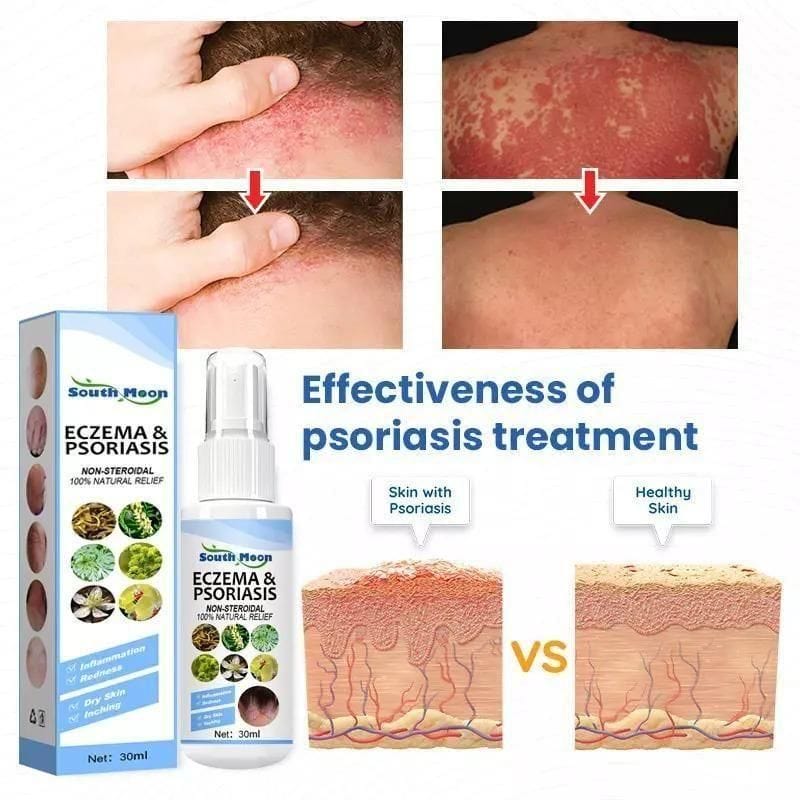 Psoriasis Treatment Vitiligo And Eczema Treatment Psoriasis Skin (Pack Of 2) Herbal Psoriasis Relief Spray (Pack Of 2) Zaavio®