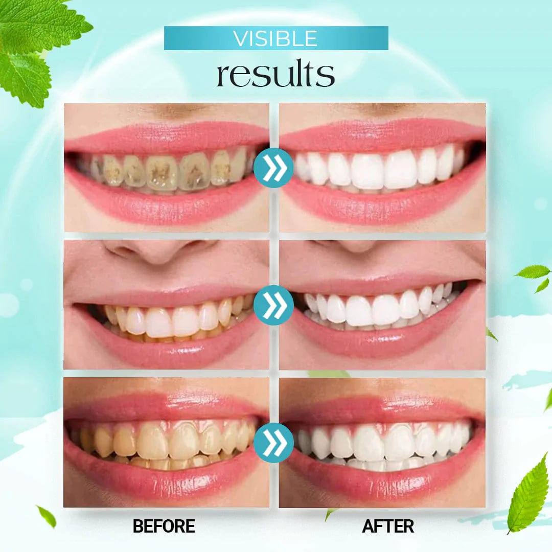 Teeth Whitening Mousse Foam Toothpaste Dental Stain Tartar Remover TeethPro™️ Foam Toothpaste Zaavio®