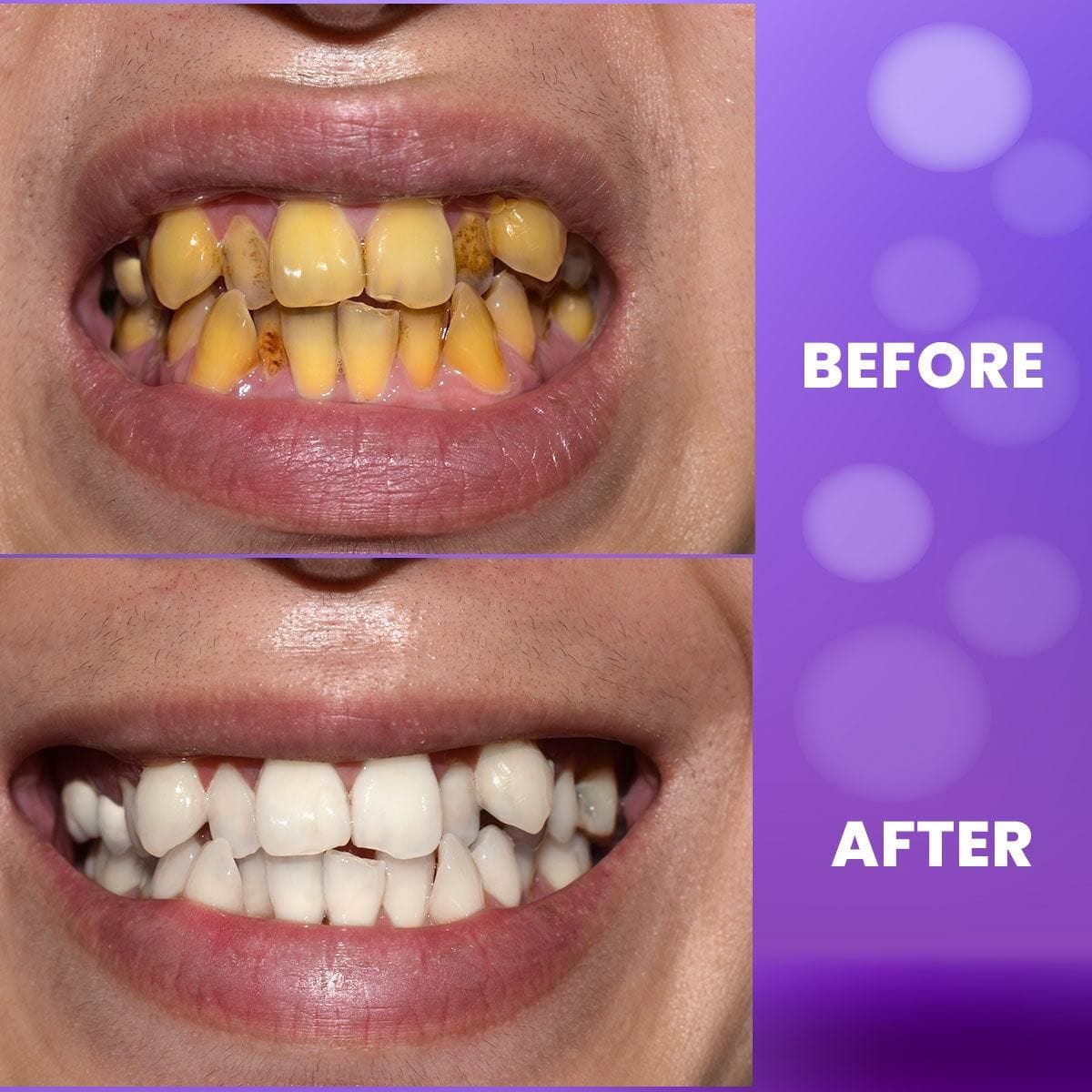 Teeth Whitening Tooth Paste Gel Whitening Pen Toothpaste- BloomBright™️ Purple Teeth Whitening Gel BloomBright™️ Purple Teeth Whitening Gel Zaavio®